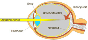 wissen kurzsichtigkeit optik hees